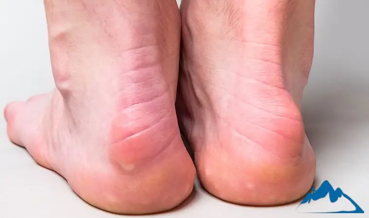 دفورمیتی هاگلند در کوهنوردان