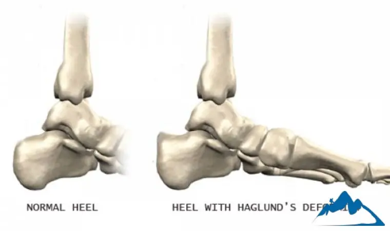 برآمدگی پشت پاشنه پا در کوهنوردی