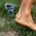 برآمدگی پشت پاشنه پا در کوهنوردان